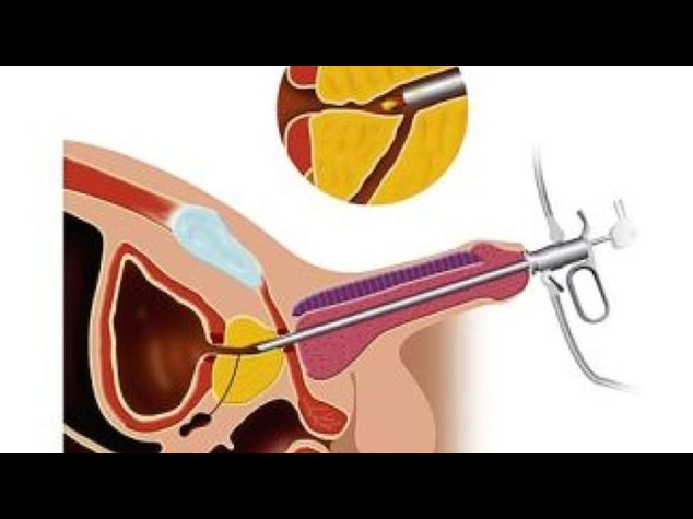 Vasectomia puo' aumentare rischio cancro prostata letale