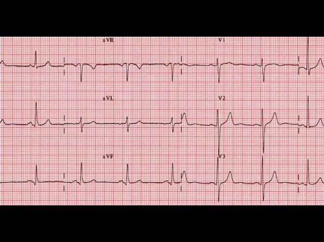 Fibrillazione atriale: individuati nuovi geni coinvolti