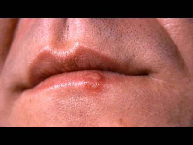 Nuove infezioni riattivano l'herpes dormiente
