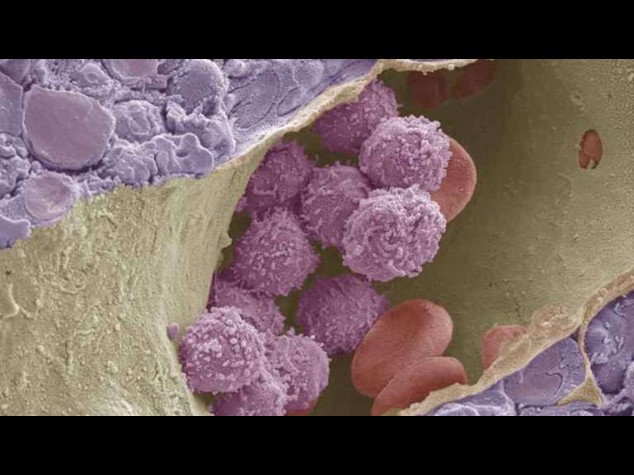 Aids: due pazienti guariscono dopo trapianto midollo in Australia