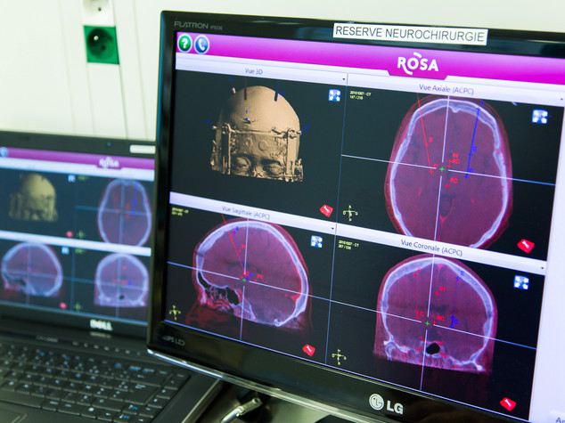Legame tra esordio precoce Parkinson e alta temperatura