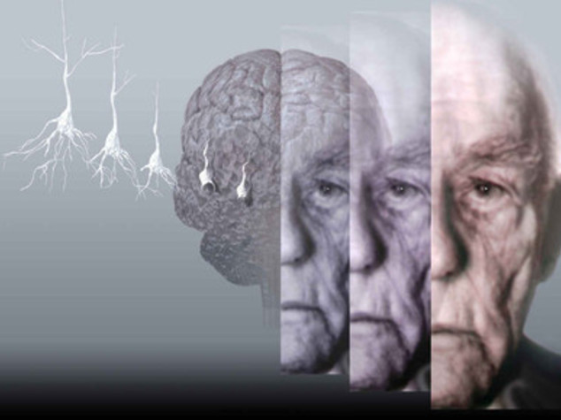 Iniezioni di proteina naturale per fermare l'Alzheimer