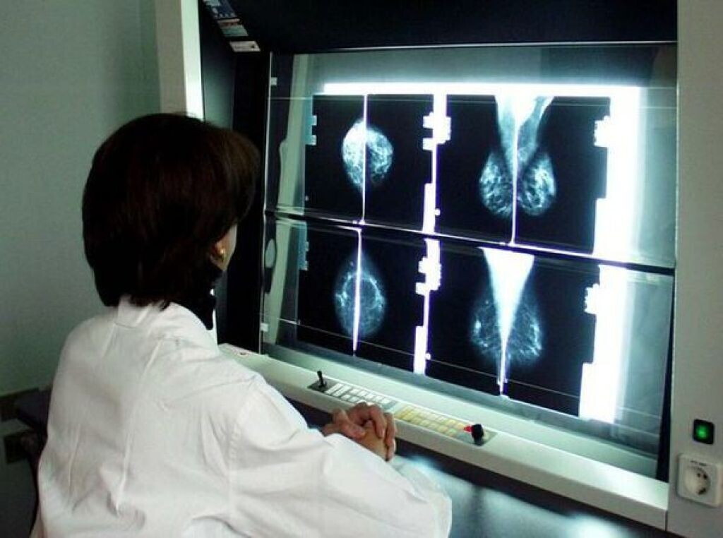 Il cancro al seno lascia "tracce" nel Dna anni prima del tumore