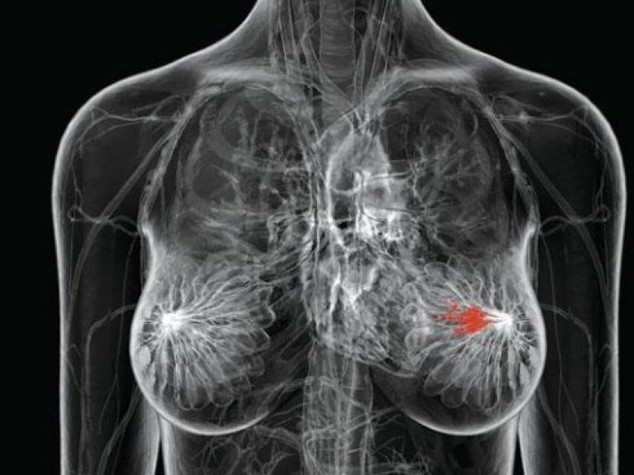 Tumori, scoperte somiglianze tra cancro seno e ovarico
