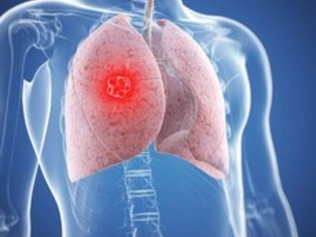 Identificate nuove mutazioni per cancro al polmone