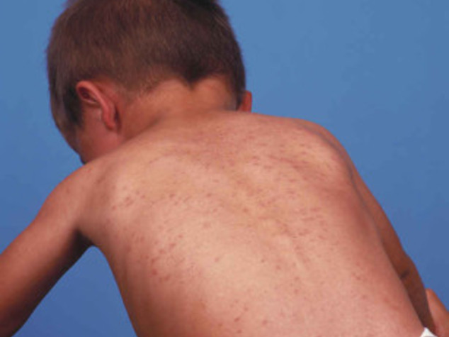 Ma quale allarmismo, quella del morbillo è un'emergenza vera