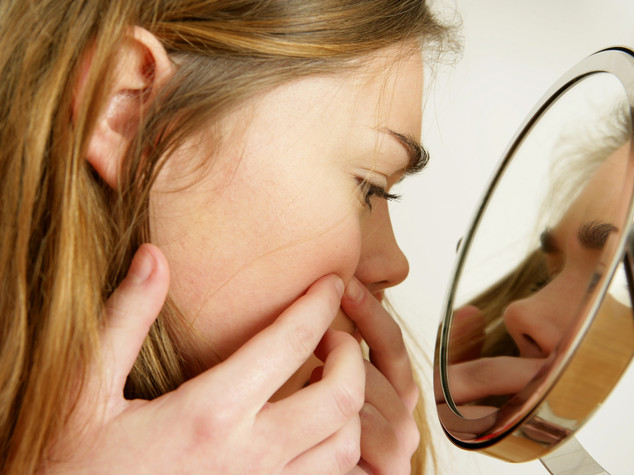 Gravita' acne legata ad alterazioni del sebo
