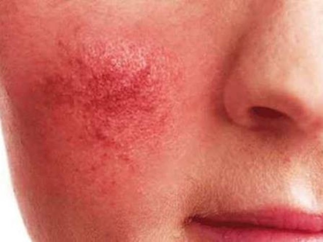 Dermatologia: studio, acne fa "scudo" contro segni invecchiamento
