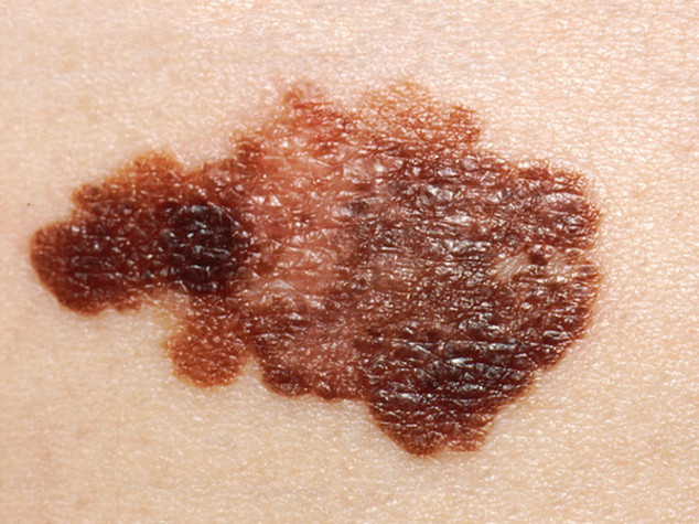 Curo' melanoma con omeopatia, medico torinese a processo