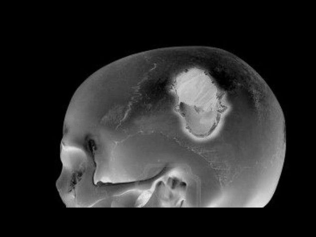 Trauma cranico lieve puo' causare danni cerebrali