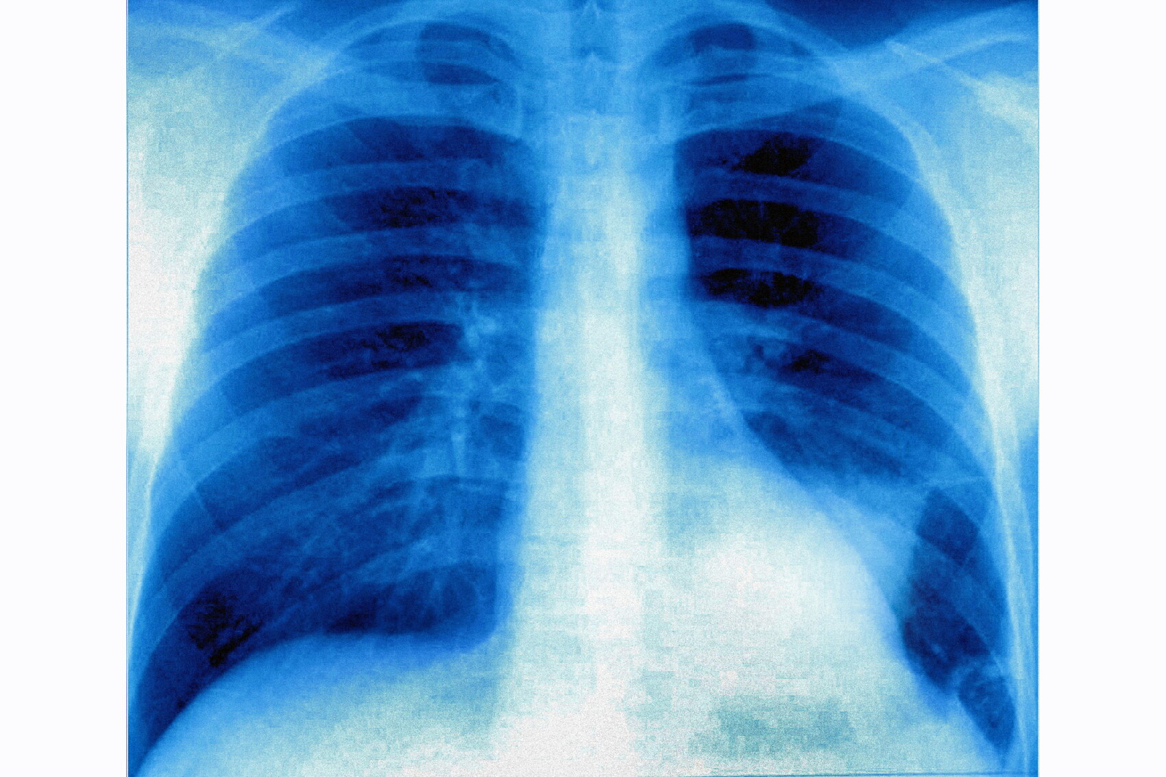 Il tumore al polmone si scopre con il test del respiro