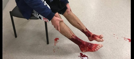 Cosa ha causato quelle ferite ai piedi del ragazzo australiano