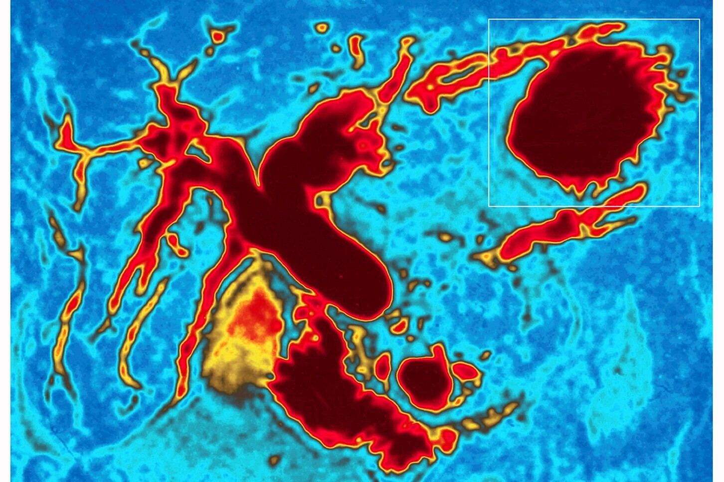 L'IA individua i segnali al pancreas fino a 3 anni prima