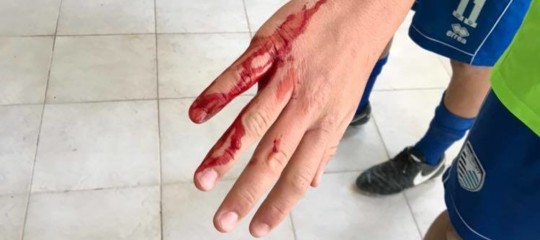 La partita tra ragazzini finisce a sprangate, tre feriti nel Salento