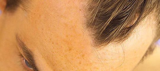 Gli uomini che perdono presto i capelli rischiano di più un infarto? Uno studio