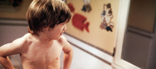 Il preoccupante ritorno del morbillo