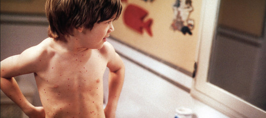 400 contagi in due mesi: sì, il morbillo torna a far paura anche tra gli adulti