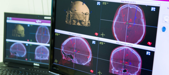 stimolazione cerebrale cura Parkinson