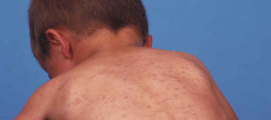 In Germania Sara Multato Chi Non Vaccina I Figli Contro Il Morbillo