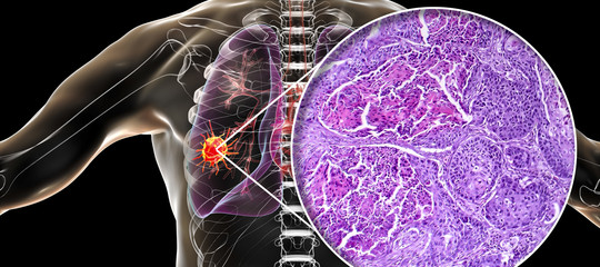 cancro polmone diagnosi precoce fumatori