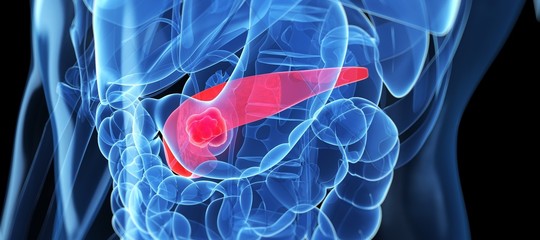 tumore pancreas terapie