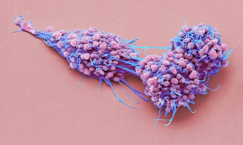 prima diagnosi precoce tumore ovarico pap test