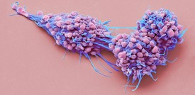 La prima diagnosi precoce per il tumore ovarico con il pap test