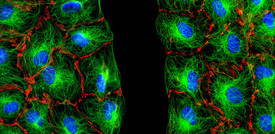Tumori ai polmoni, scoperta causa della resistenza a immunoterapia