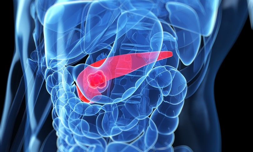 nuova terapia contro tumore al pancreas