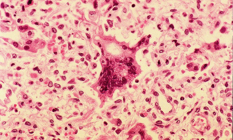 effetti collaterali covid diffusione morbillo