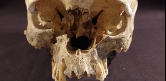 Il cranio di una donna svela un rituale di 5.000 anni fa