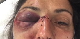 I No Tav accusano: "Manifestante gravemente ferita da un lacrimogeno". La Polizia: "È falso"