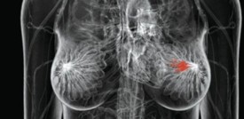 L'Ema ha autorizzato un farmaco contro il cancro mammario avanzato
