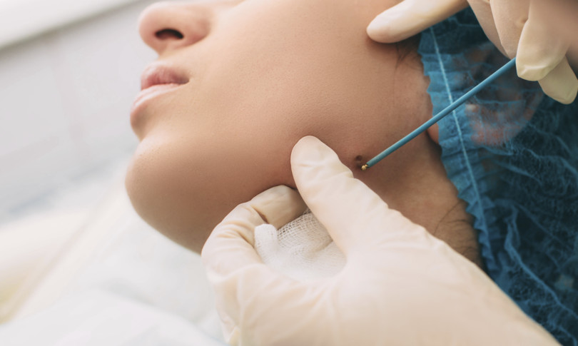 italia crescono casi melanoma