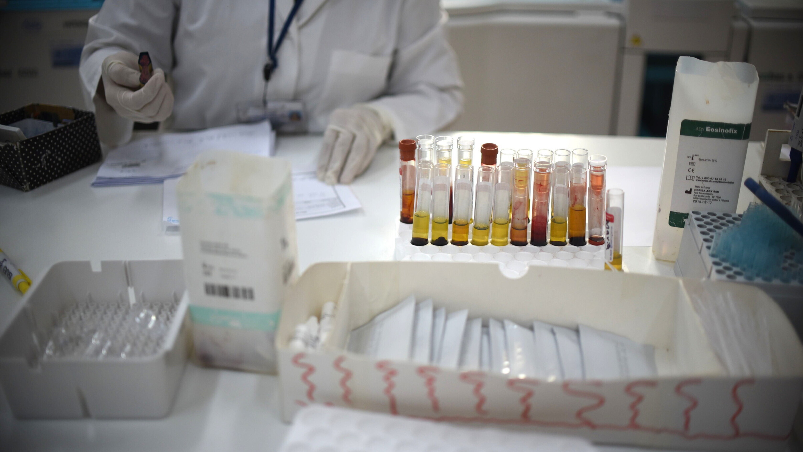 L'infezione prenatale da Zika ha conseguenze a lungo termine nei bambini