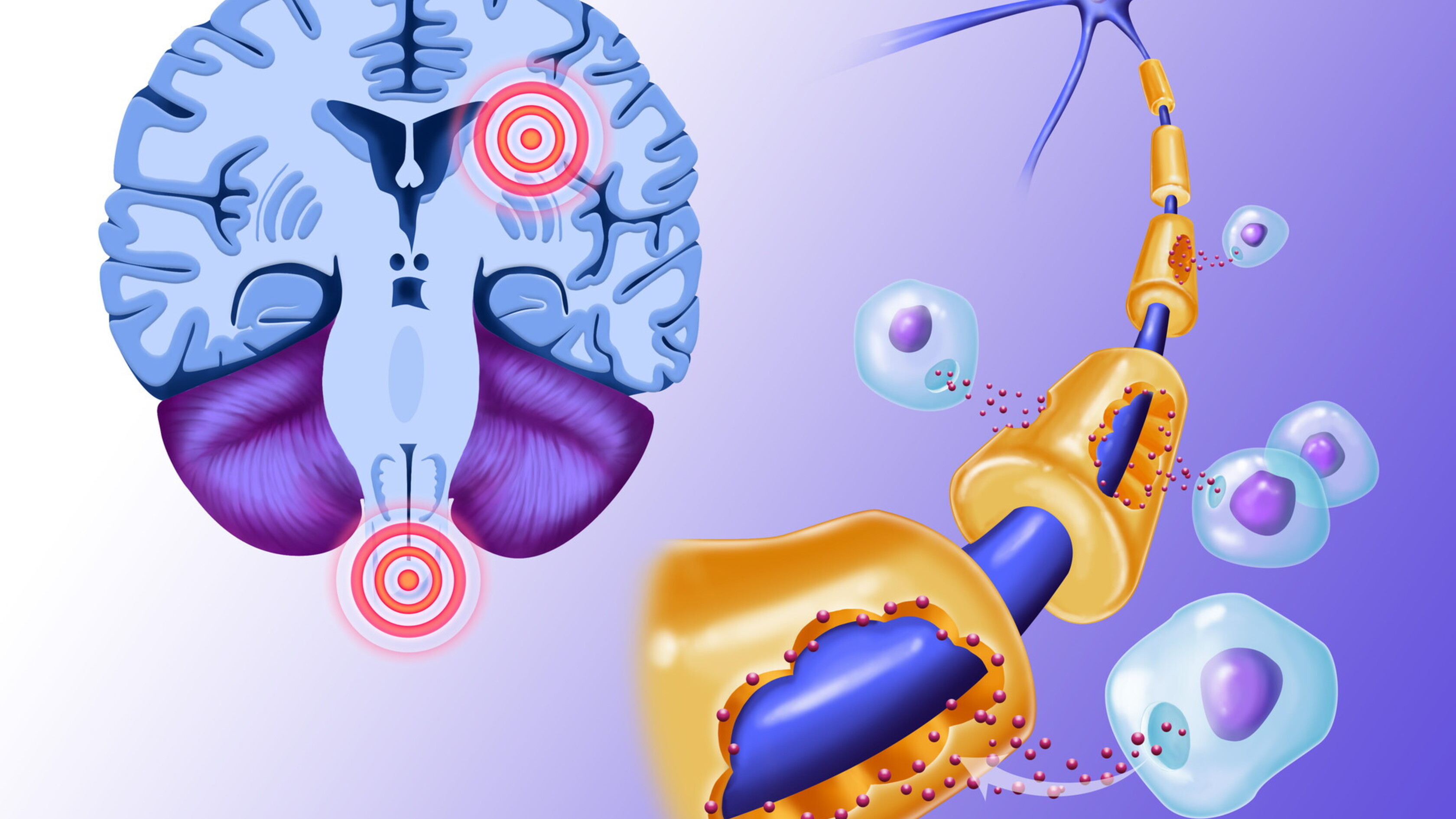 Sla, dalla stimolazione cerebrale una nuova speranza per rallentare la malattia  