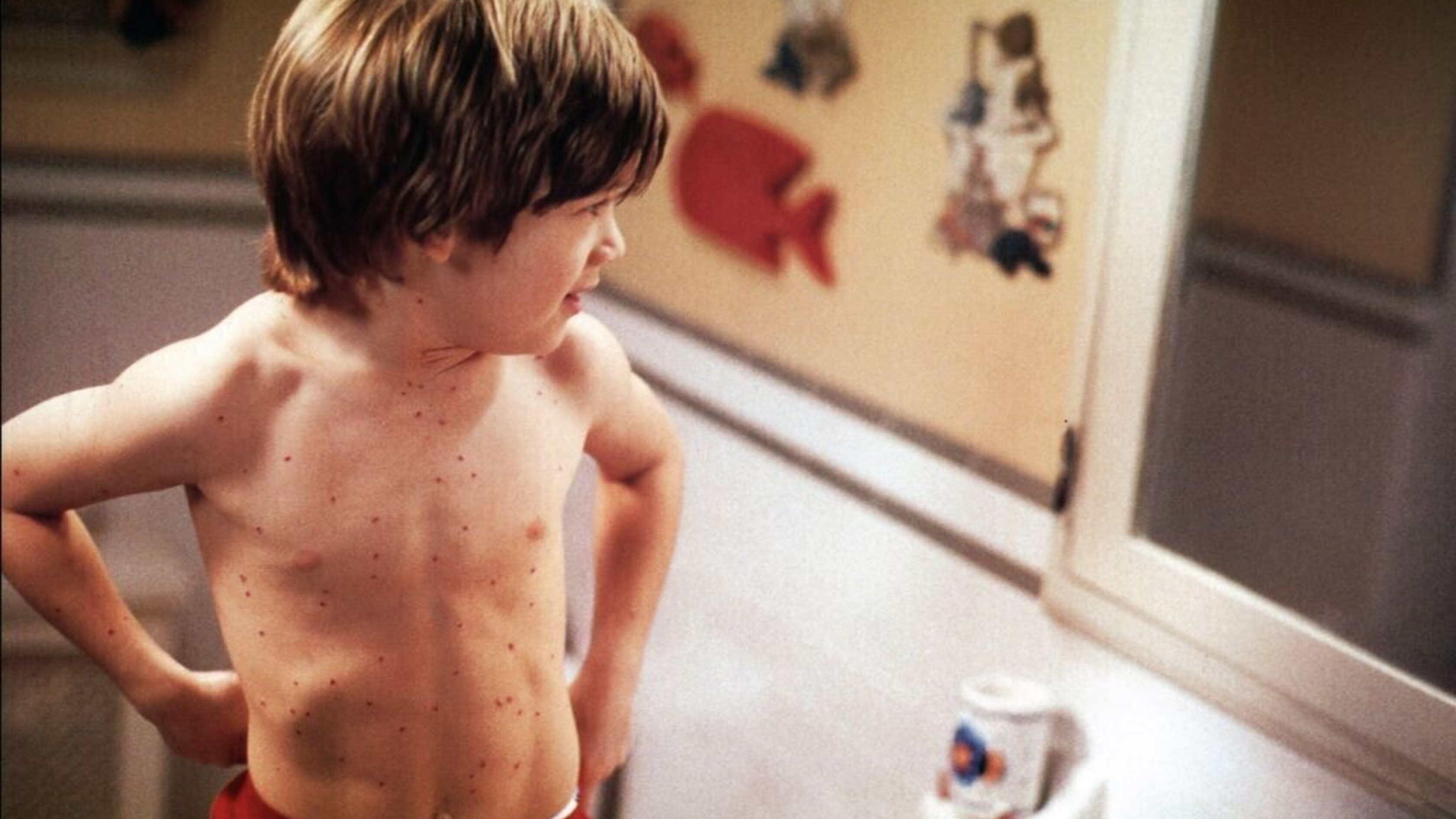 Nel 2024 in Italia 807 casi di morbillo e 2 di rosolia