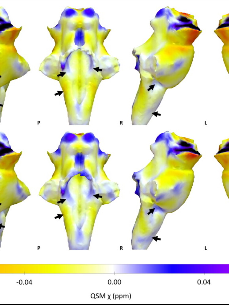 Il long Covid dipende dai danni al centro di controllo del cervello