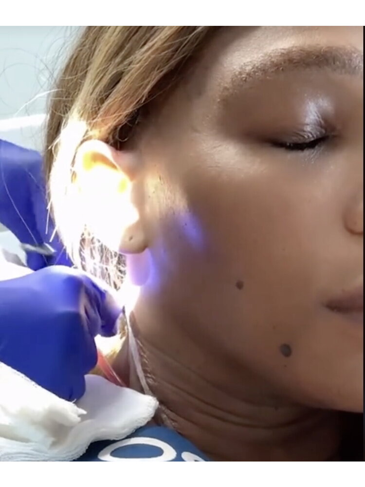 Serena Williams su TikTok: "Avevo una cisti brachiale grande quanto un pompelmo"