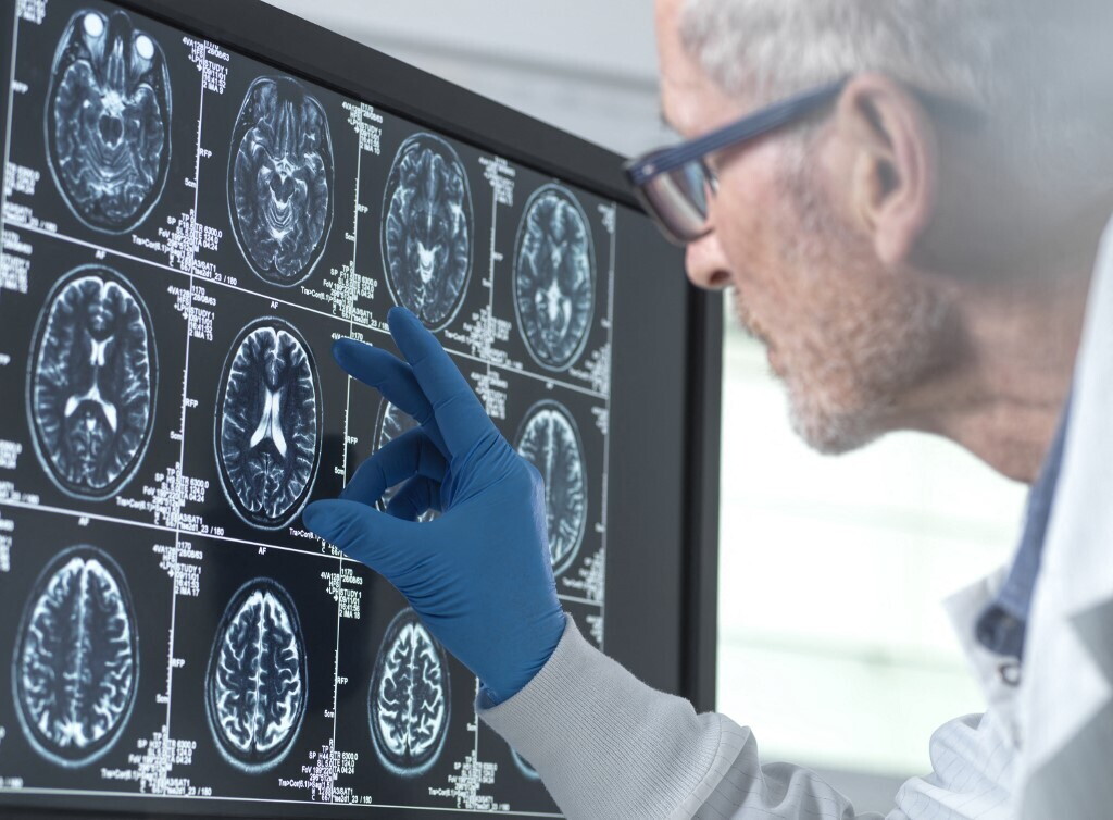 Scoperti nuovi geni chiave per il cervello e l'autismo