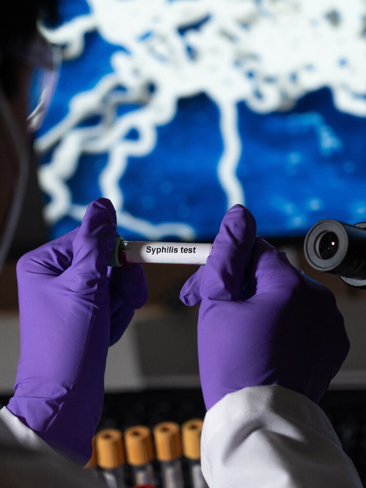 In aumento le malattie sessualmente trasmesse