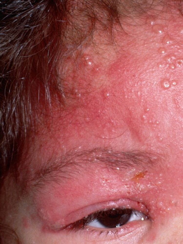 L'Herpes zoster può provocare infezioni al sistema nervoso