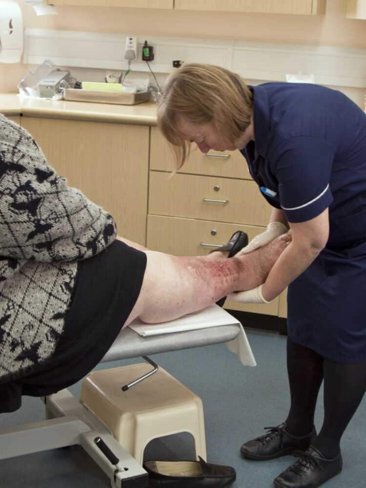 Linfedema, in Italia ogni anno 40mila nuovi casi. L'allarme della Sicpre