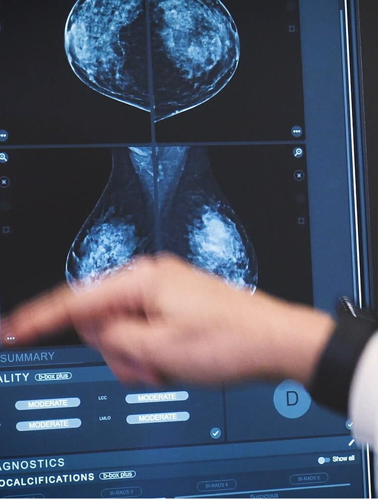 Tumori al seno, all'Humanitas diagnosi precoce grazie all'IA