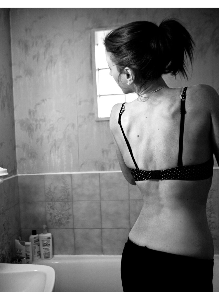 L'anoressia nervosa colpisce in Italia 540mila le donne. Ecco come pianificare la cura più efficace