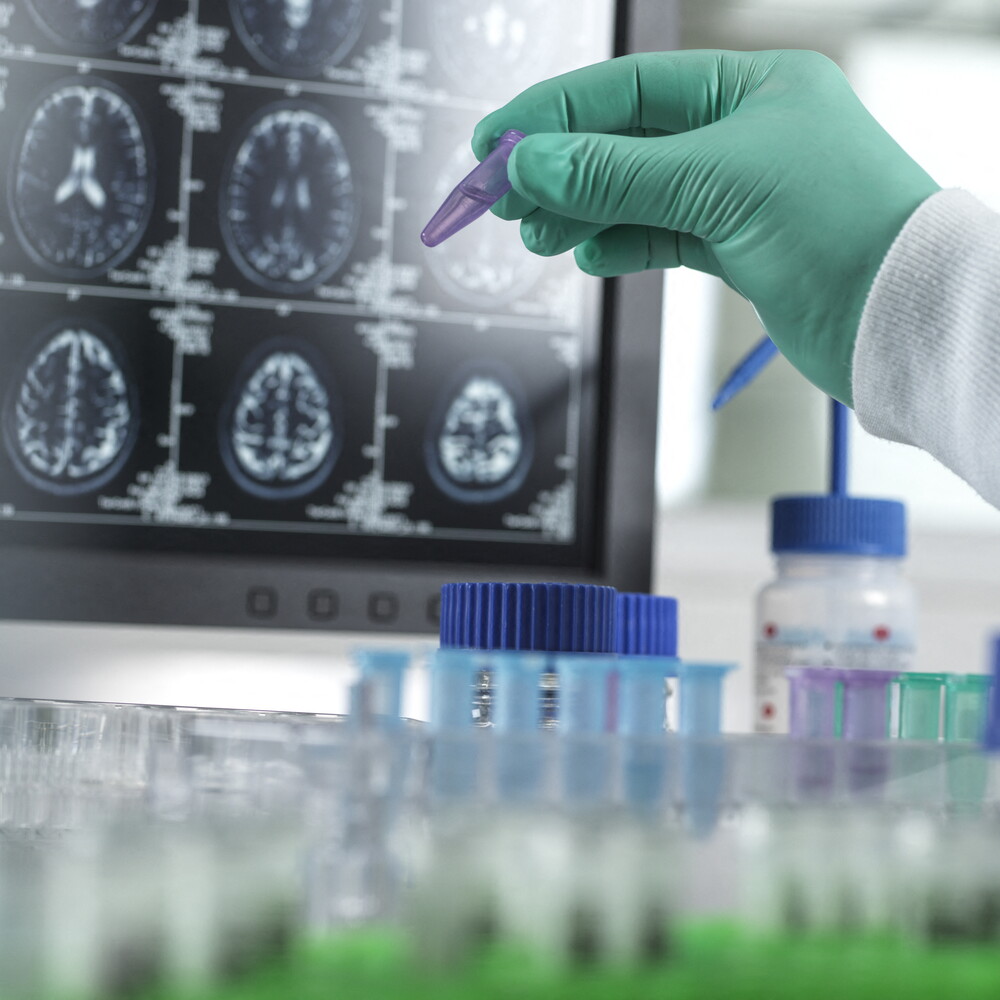 Con sindrome metabolica aumento del rischio di demenza