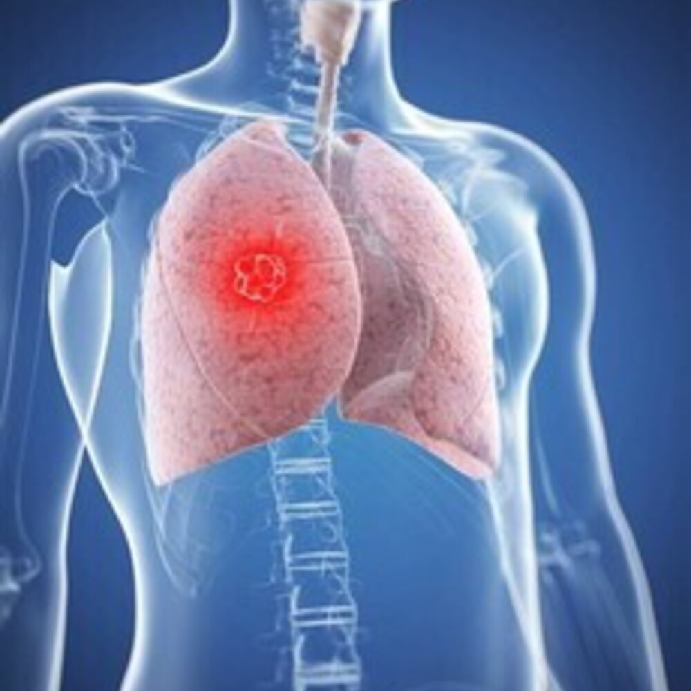 Nuovo farmaco contro il tumore ai polmoni. Riduce del 40% il rischio di morte