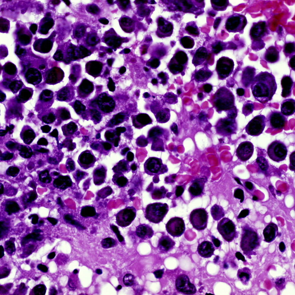 Mieloma multiplo, un tris di farmaci triplica la sopravvivenza