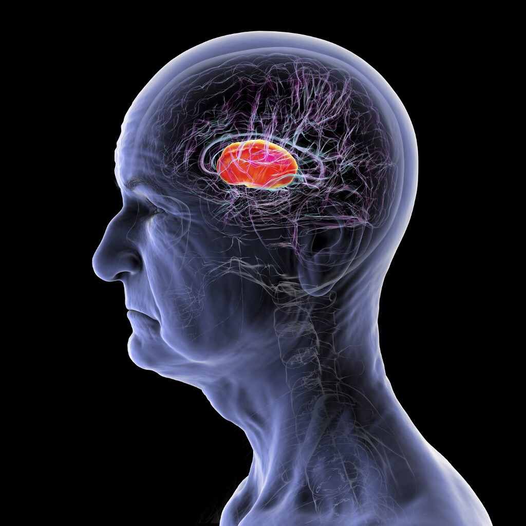 Ultrasuoni come terapia non invasiva per il recupero cerebrale dopo un ictus