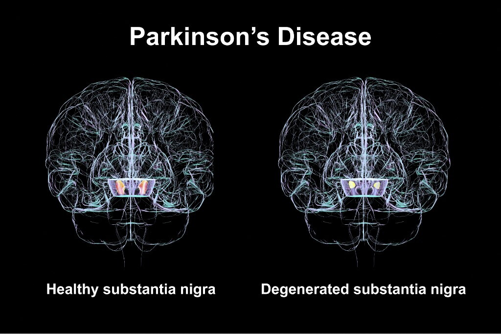 Non sottovalutare l'apnea notturna, può provocare il Parkinson